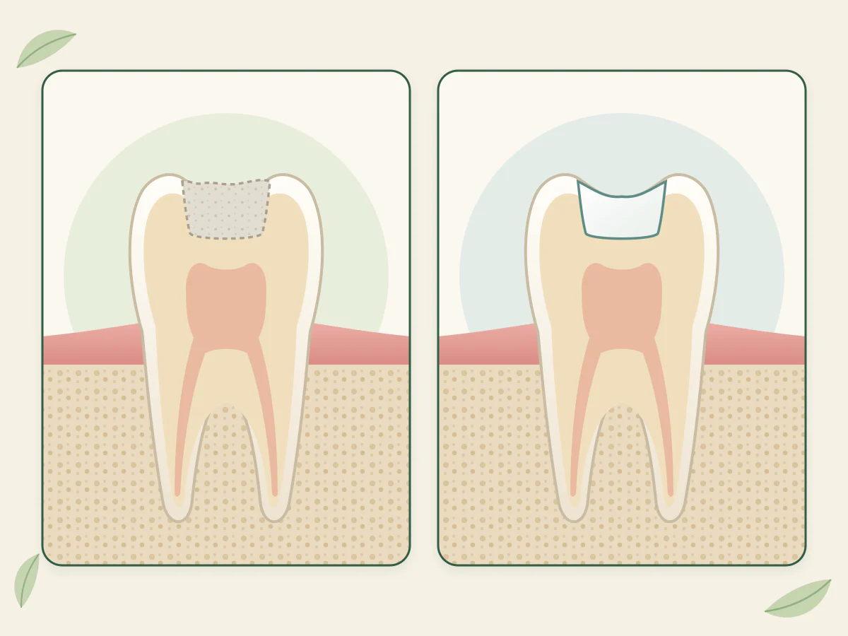 Deux coupes d'une même molaire : à gauche, une pâte grise à contour pointillé remplit le trou ; à droite, une restauration blanche et lisse, au ras de la surface.