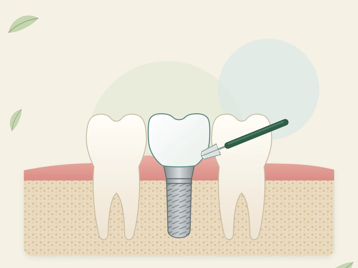 Trois dents du bas : deux molaires naturelles et une couronne sur implant au milieu ; une brossette interdentaire est dans l'espace voisin, au-dessus de la gencive.