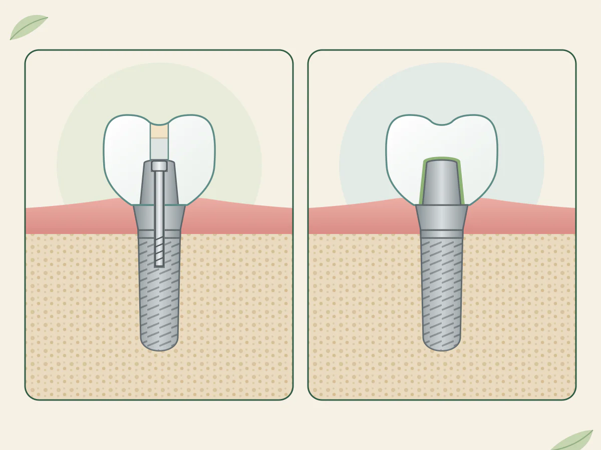 Deux coupes de molaire sur implant : à gauche, une vis traverse couronne et pilier, trou refermé en haut ; à droite, couronne fixée au pilier par un ciment vert.