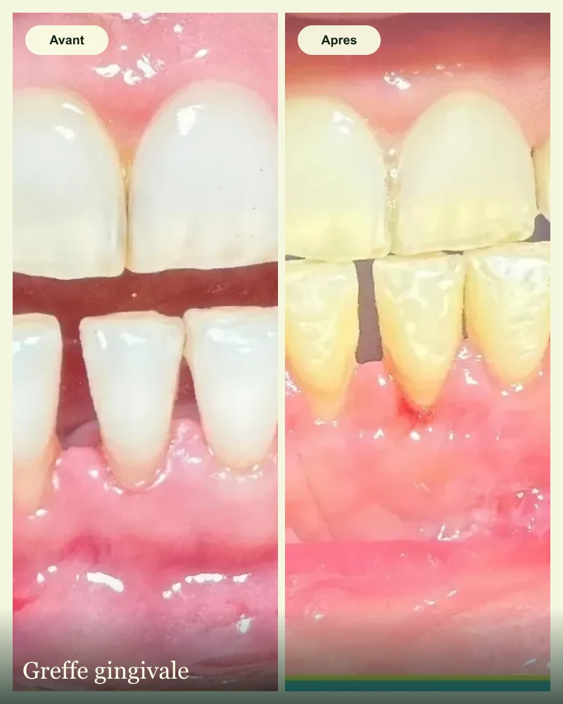 Cas clinique avant apres : greffe gingivale et restauration des tissus