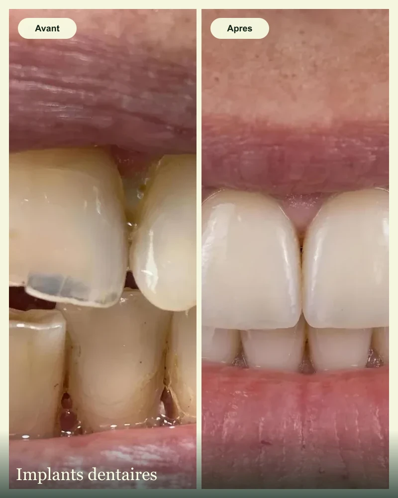 Cas clinique avant apres : implants dentaires et couronnes ceramiques