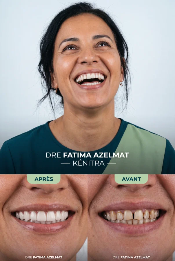Résultat avant / après implants — Dre Fatima Azelmat, Kénitra